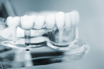 ensure great smile with dental implants