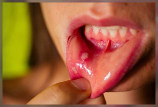 analyzing canker sores 