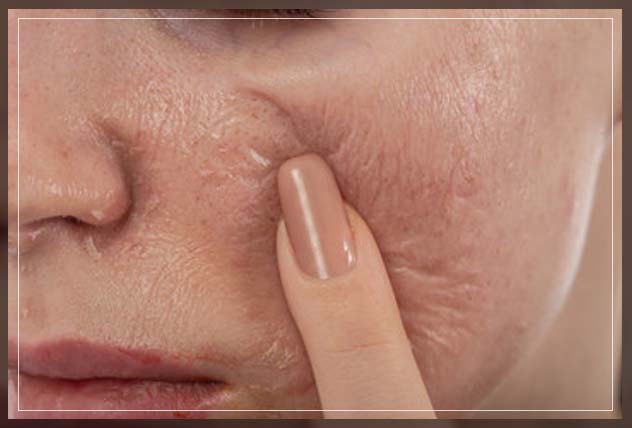 going for a home or professional peel