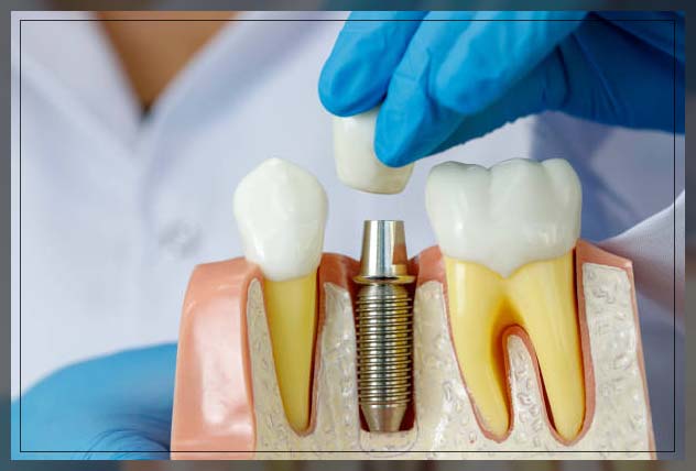 cost of dental implant