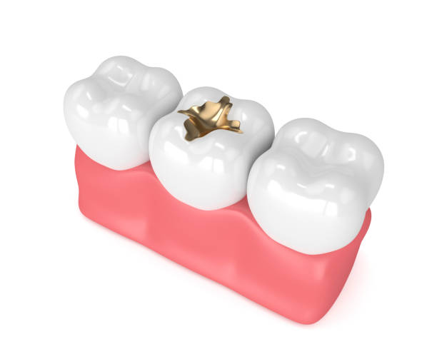 gold fillings in dubai