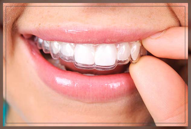 invisalign