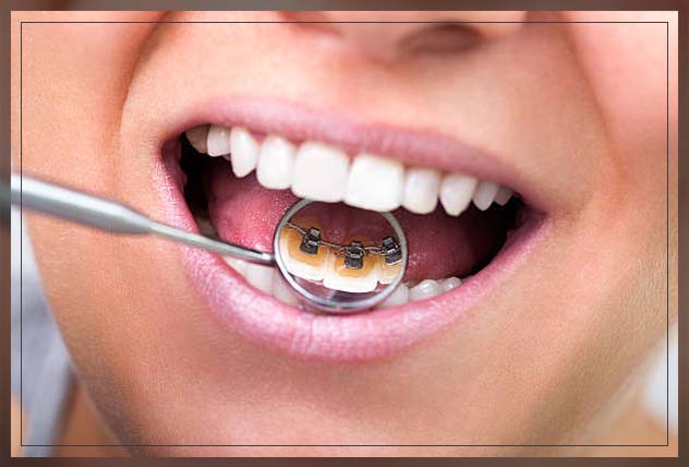 lingual braces