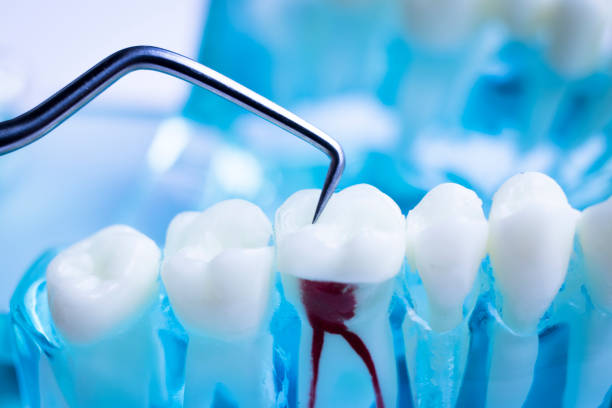 root canal treatment in jumeirah