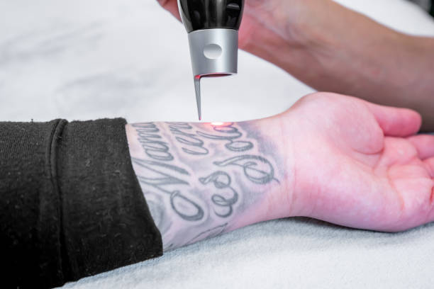 tattoo removal al wasl dubai