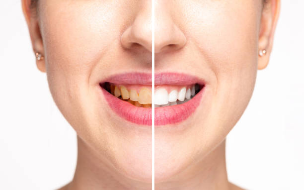 Hismile teeth whitening image