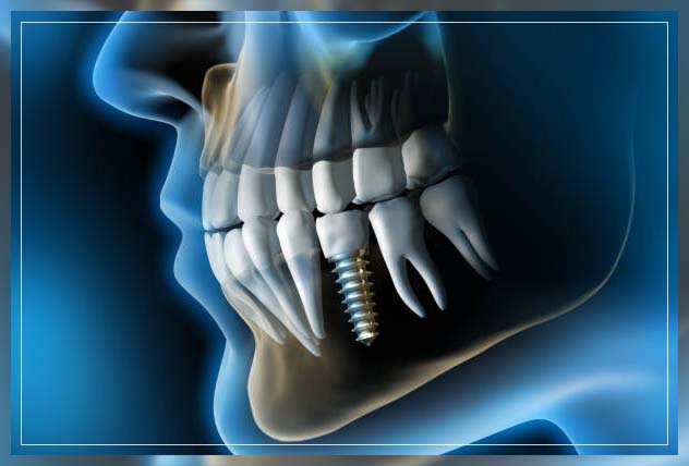 types of implant in Dubai