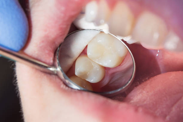 Dental Bridges and Crown