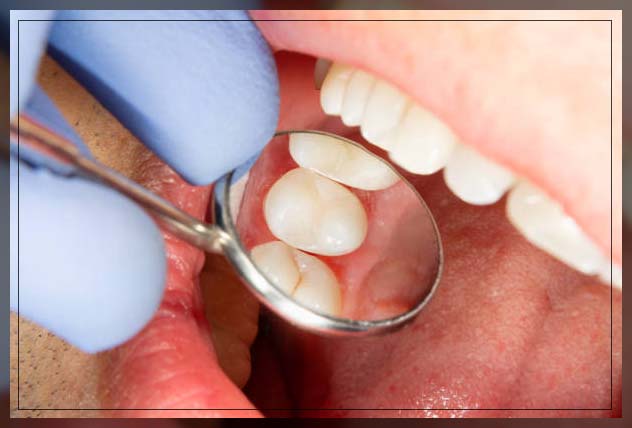 Dental filling 15