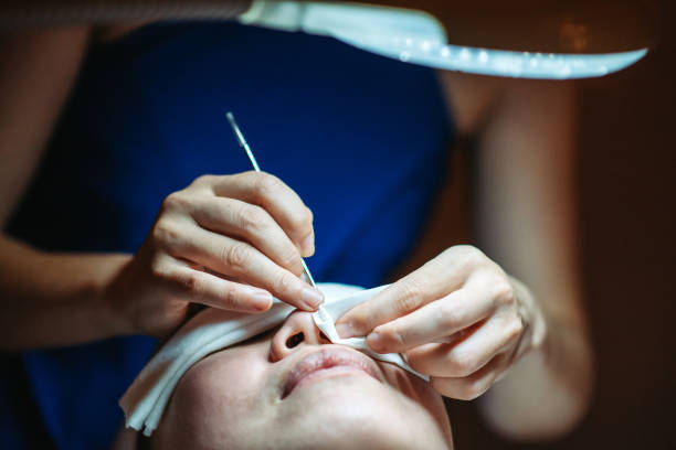 professional blackhead removal