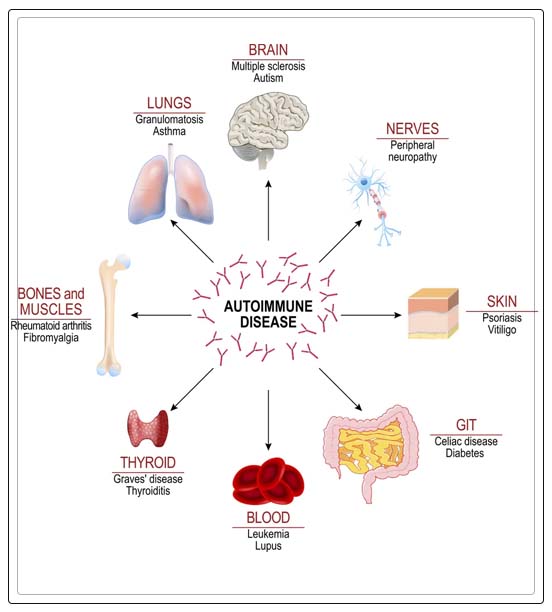 symptoms of celiac disease 