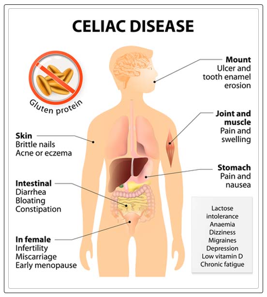 how to contract a celiac disease 
