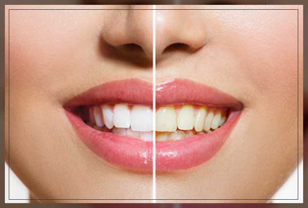 why you should get dental whitening ?