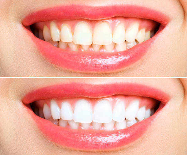 dental whitening