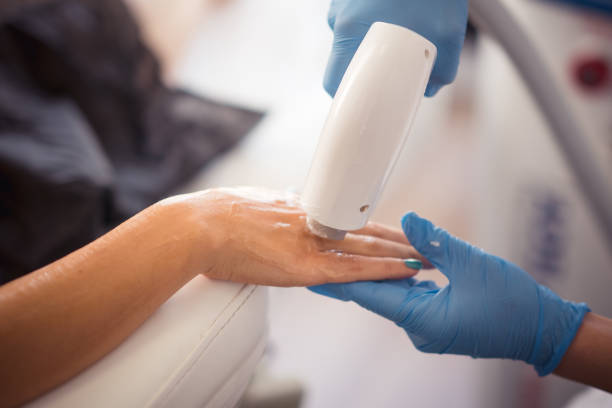 REPC laser skin treatment