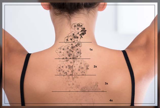 how lasers remove tattoo