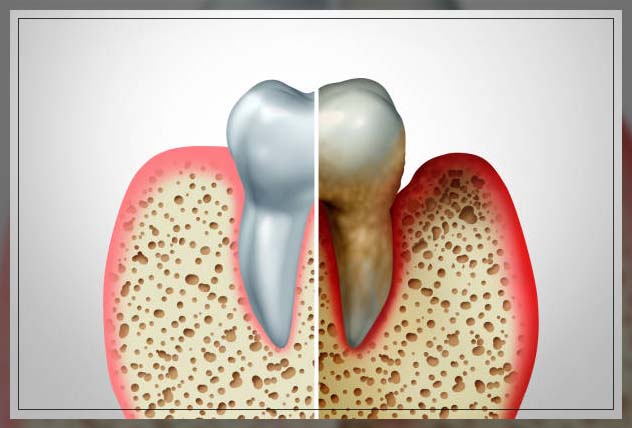 osteoporosis 13