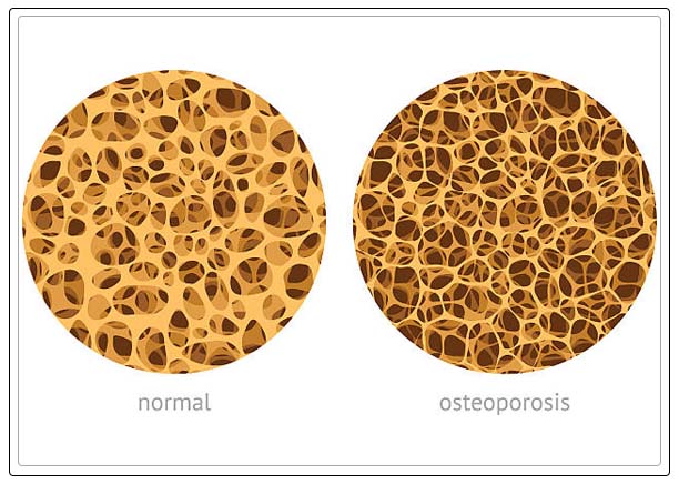 osteoporosis 17