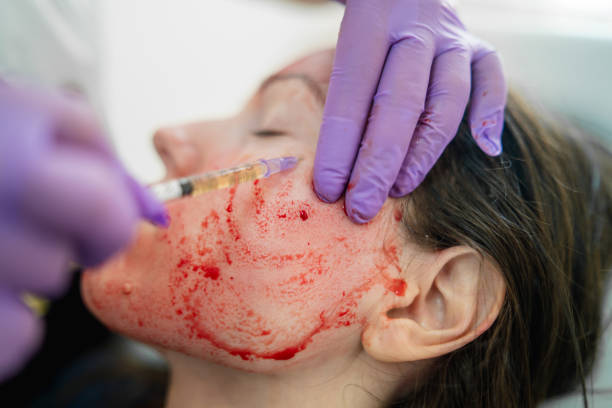 vampire facial procedure