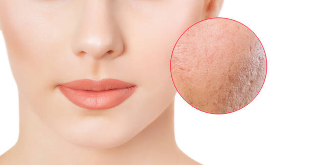 what to expect laser skin resurfacing