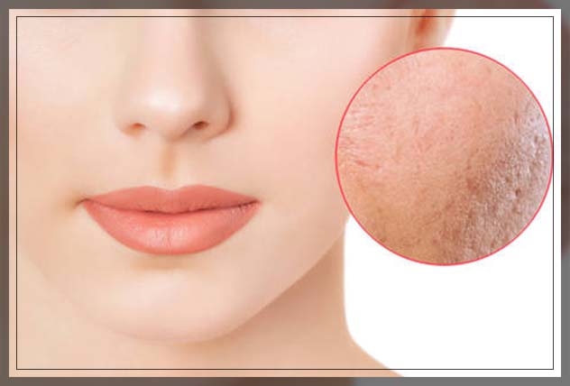 CO2 skin laser resurfacing 2