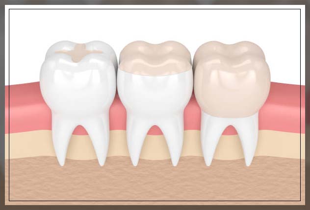 Composite filling 11