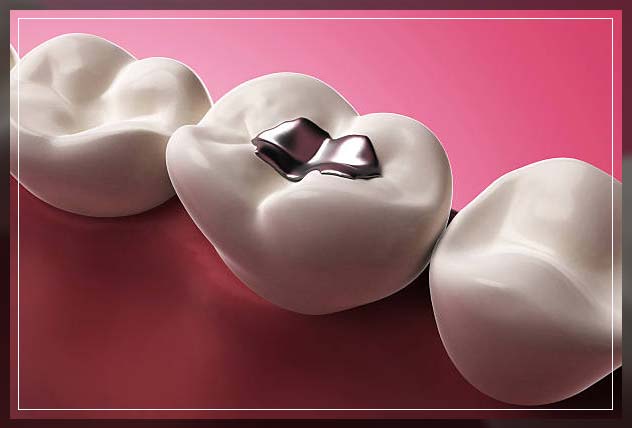 Composite filling 14