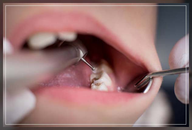 Composite filling 16