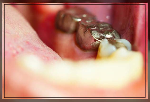 Composite filling 17