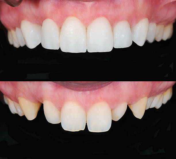 Dental Veneers