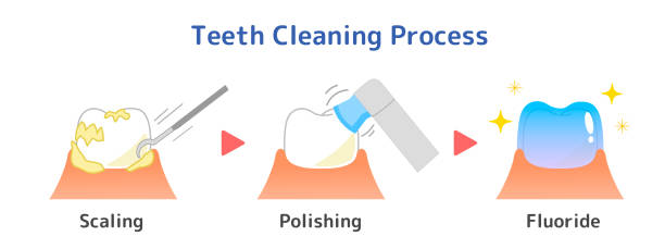 Dental Scaling and Polishing