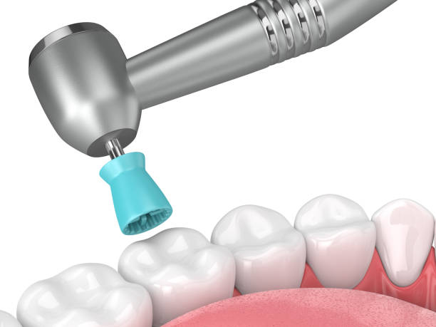 Dental Scaling and Polishing