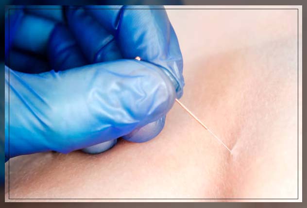 Dry needling 12
