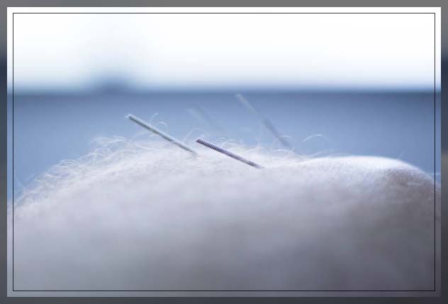 Dry needling 15