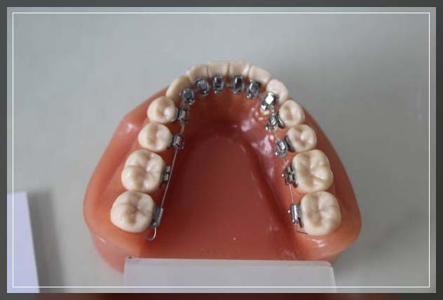 Lingual braces 17