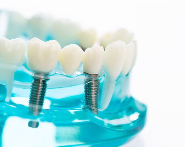 dental implants