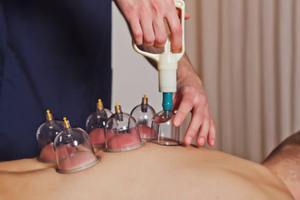 dry cupping procedure