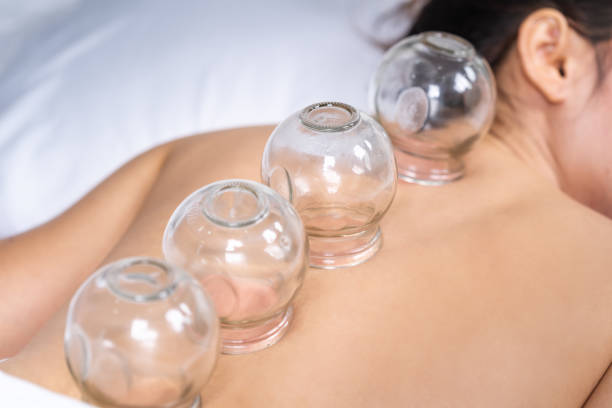 dry cupping