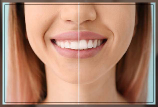 understaning what is gum contouring