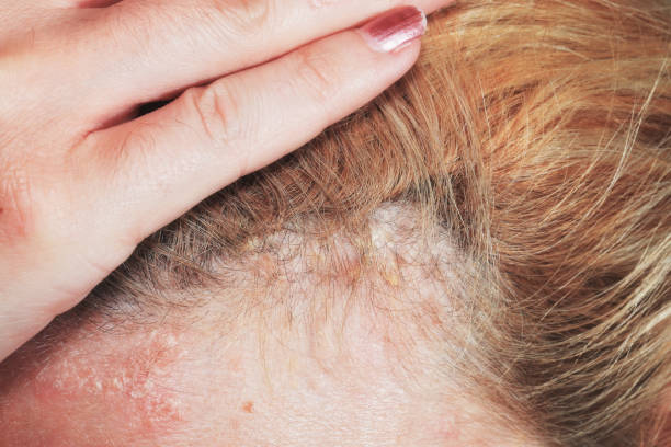 psoriasis on scalp