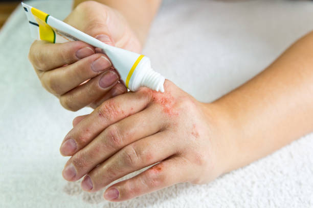 treamtent of psoriasis