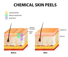 three types of chemical peels
