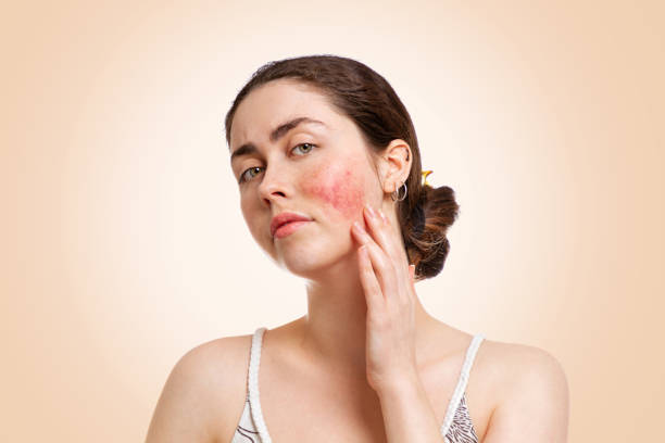 Skin diseases Rosacea