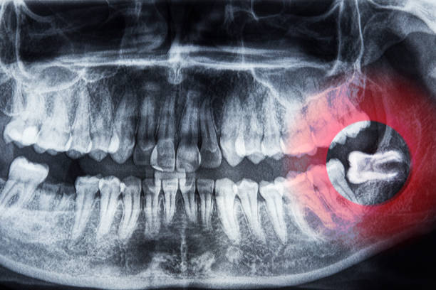 Wisdom teeth 2