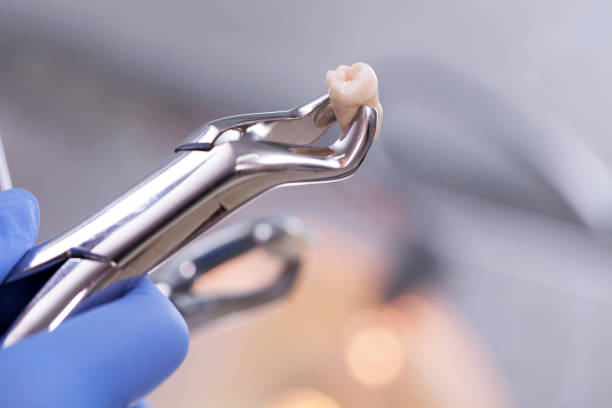 Wisdom teeth 5