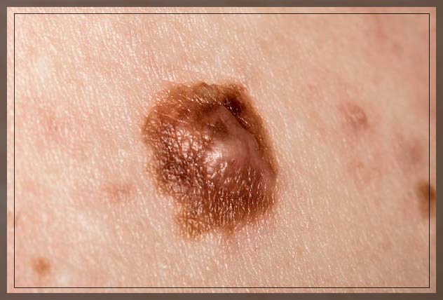 cancerous mole removal