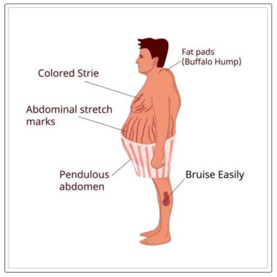 Cushing Syndrome: Everything You Need to Know - REPC