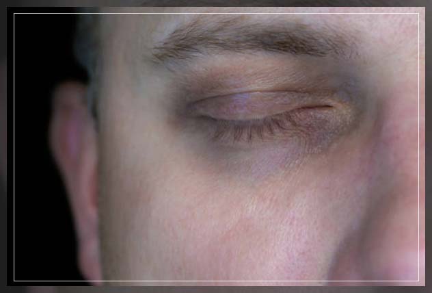 man having dark circles