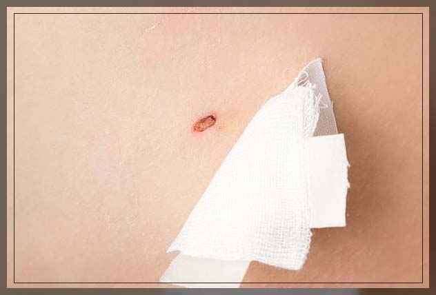 mole removal aftercare with bandage