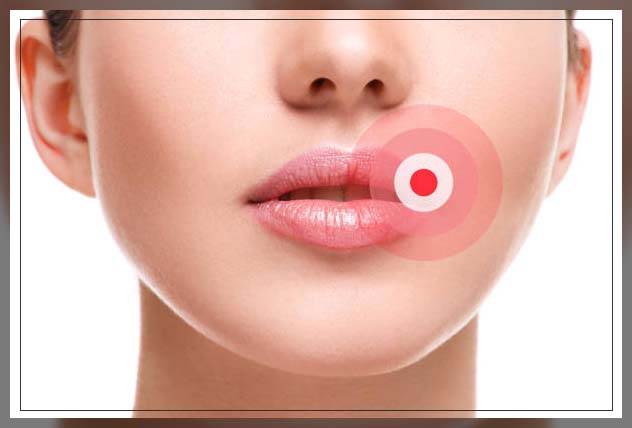 cold sores on woman's face